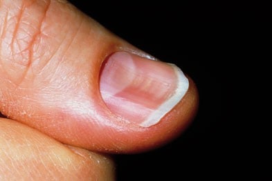 what are fingernail and toenail abnormalities?